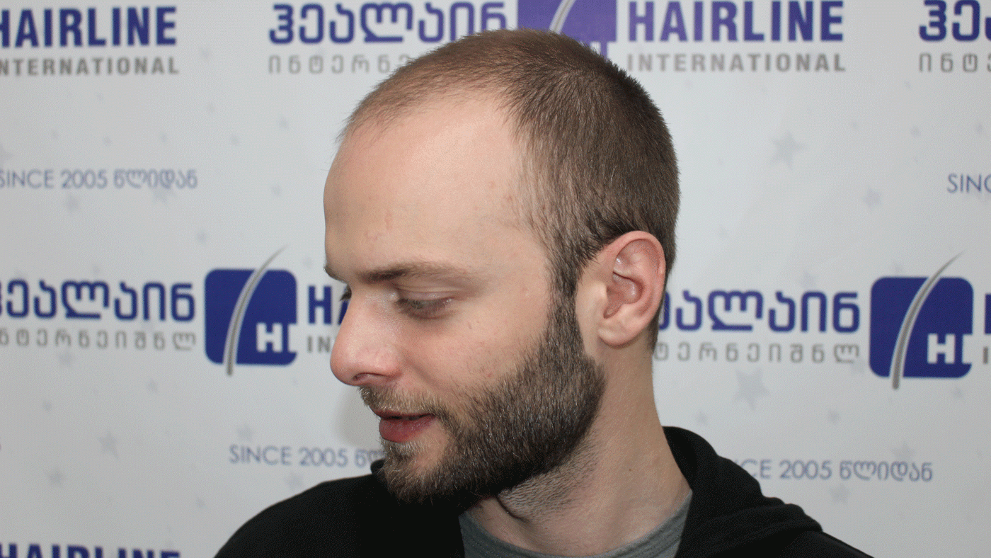 3 Day Hair Transplantation