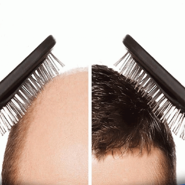 Hair transplant in Georgia